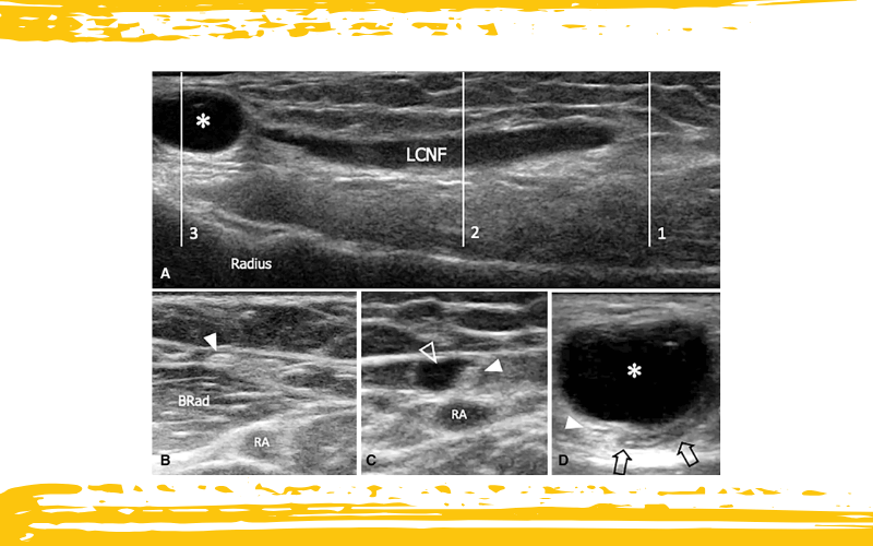 6. Nervio cutáneo lateral antebrazo.png